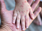 Suman 21 casos de sarampión en Tabasco