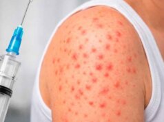 Reporta Salud Tabasco 7 casos de sarampión en lo que va de 2026